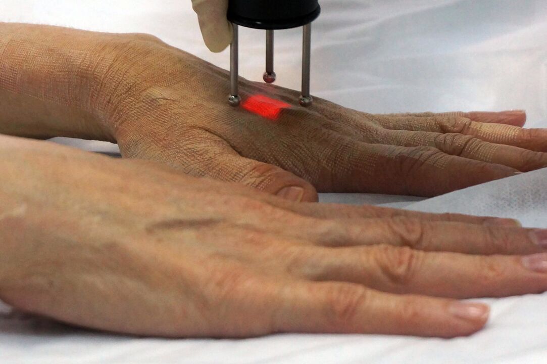 Rejuvenescimento a laser das mãos com método não ablativo