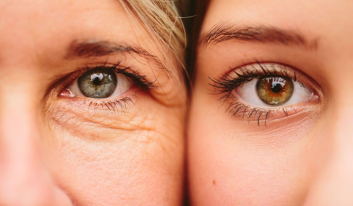 sinais de envelhecimento ao redor dos olhos
