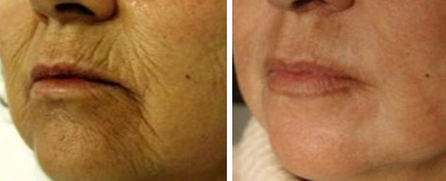 Rejuvenescimento 4d