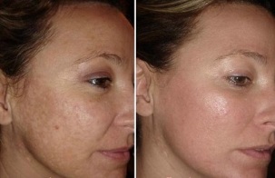rejuvenescimento da pele facial a laser antes e depois das fotos